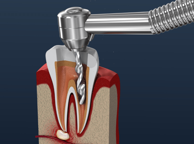 A stepbystep guide to the endodontic workflow